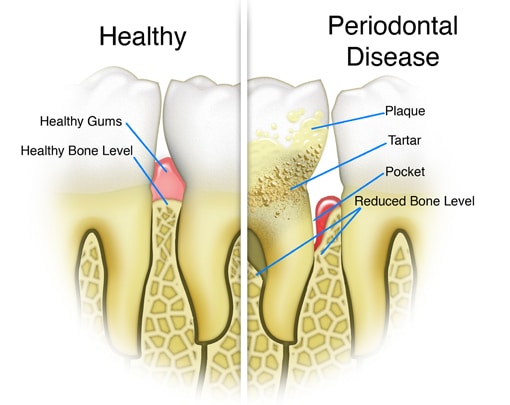 Gum Disease Therapy | Havelock | Dr. Vipin Grover