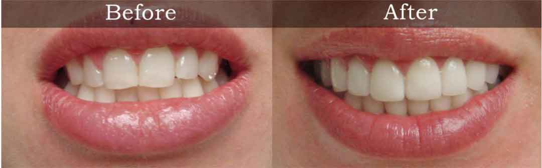 Cosmetic Dentistry | Havelock | Dr. Vipin Grover